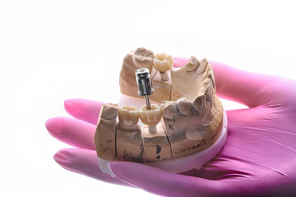 Understanding Bone Grafting: How It Restores Jawbone Health And Strength