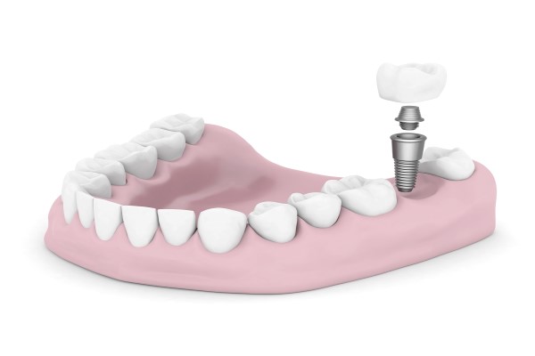 Prostheses Commonly Used With Dental Implants